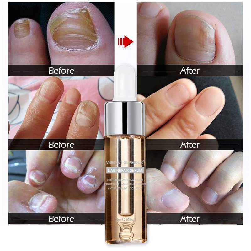 NAIL FUNGUS Care - NAIL REPAIR FLUID - Hand & Foot - Bright Nail - Yo'rTotal Beauty