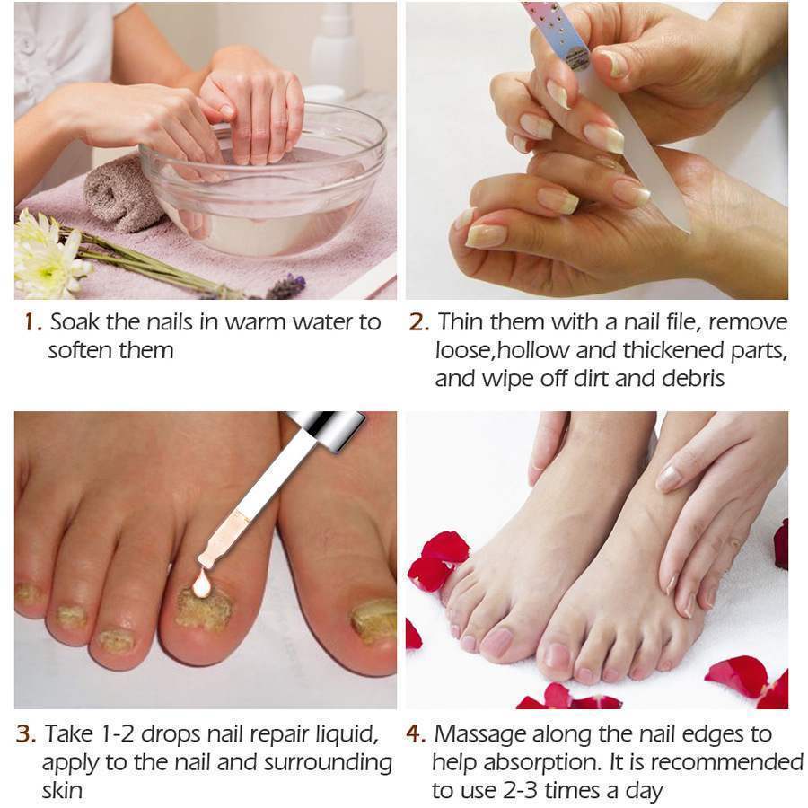 NAIL FUNGUS Care - NAIL REPAIR FLUID - Hand & Foot - Bright Nail - Yo'rTotal Beauty