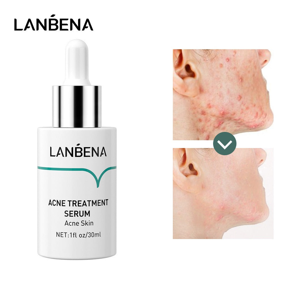 ACNE TREATMENT SERUM - LANBENA - (30ml or 15ml) - Yo'rTotal Beauty