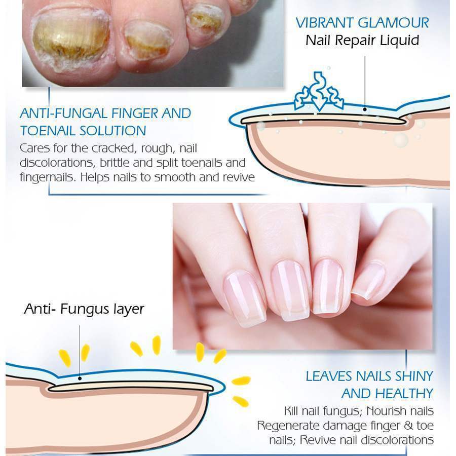 NAIL FUNGUS Care - NAIL REPAIR FLUID - Hand & Foot - Bright Nail - Yo'rTotal Beauty