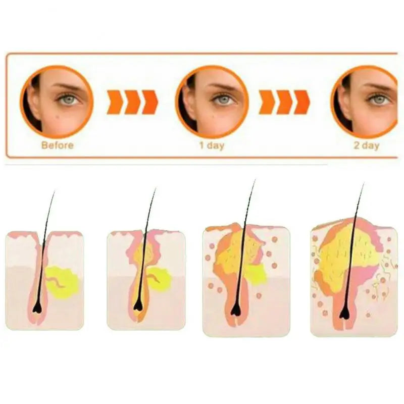 36pcs (per set) Pimple Remover - Master Patch Acne Treatment - INVISIBLE ACNE PATCH- Face Skin Care Tools - Yo'rTotal Beauty