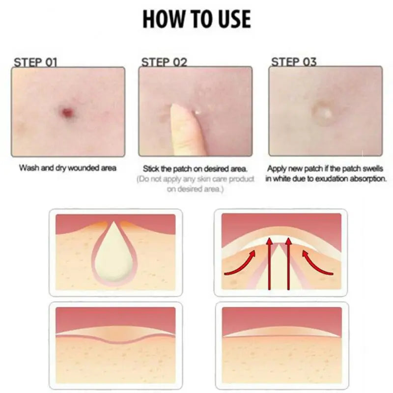 36pcs (per set) Pimple Remover - Master Patch Acne Treatment - INVISIBLE ACNE PATCH- Face Skin Care Tools - Yo'rTotal Beauty