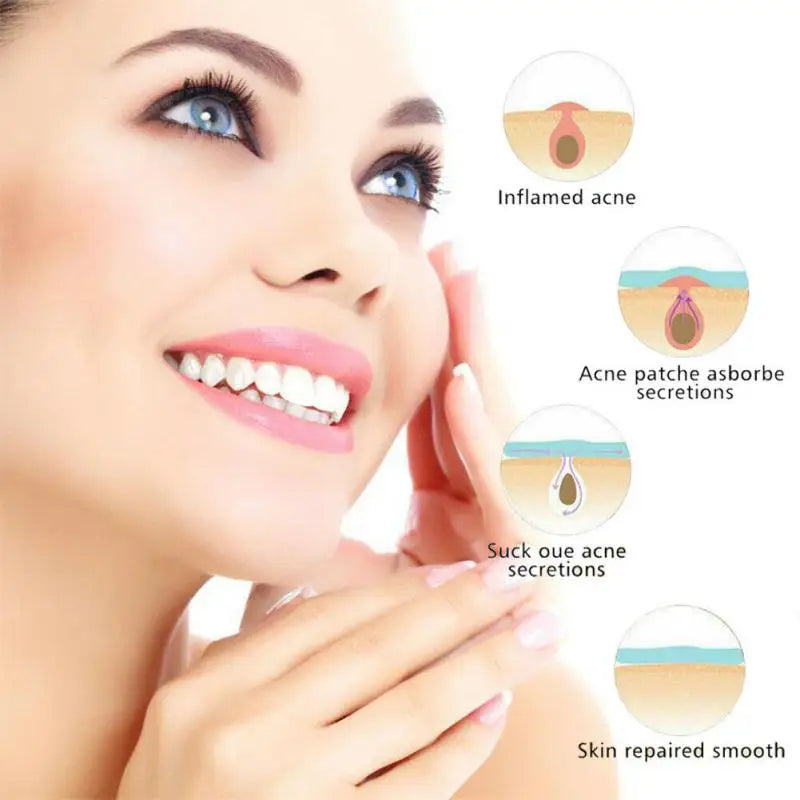 36pcs (per set) Pimple Remover -  Master Patch Acne Treatment - INVISIBLE ACNE PATCH- Face Skin Care Tools - Yo'rTotal Beauty