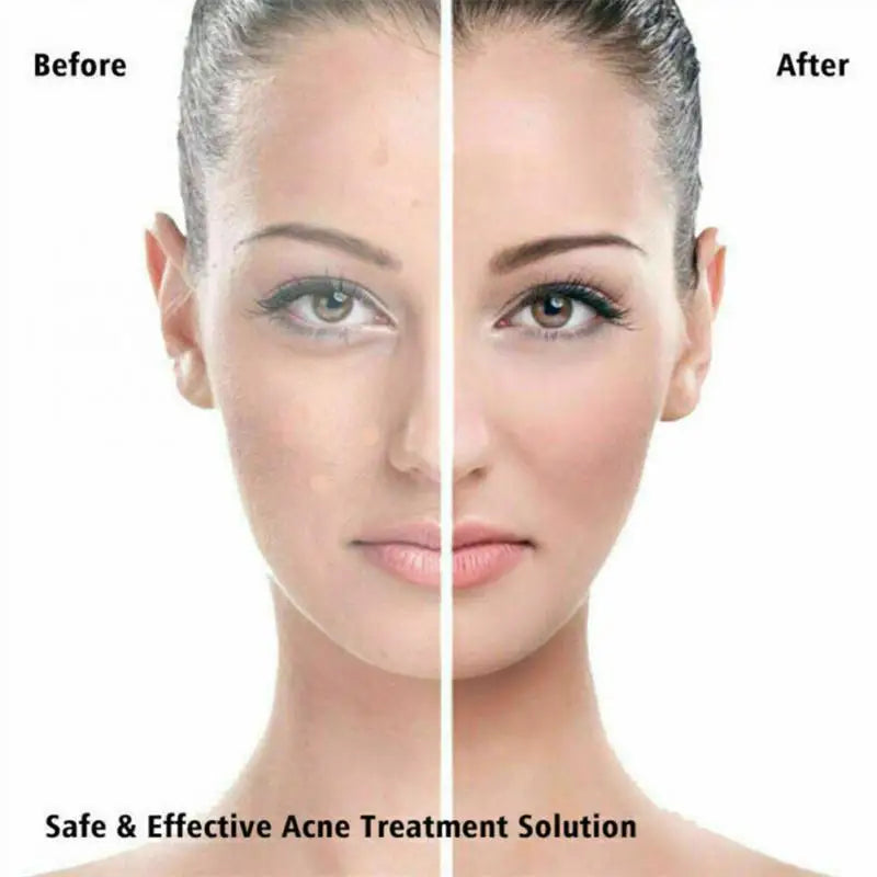 36pcs (per set) Pimple Remover - Master Patch Acne Treatment - INVISIBLE ACNE PATCH- Face Skin Care Tools - Yo'rTotal Beauty